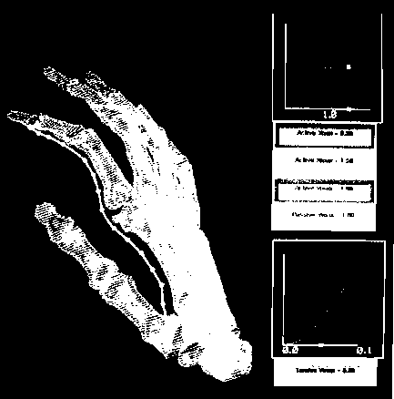 Одна часть стереоскопической пары изображений, на которой показаны кости человеческой руки, нарисованные Ин-мо Юн (Inmo Yoon), Д. Томпсоном (D. Thompson) и У. Н. Воггенспаком мл. (W. N. Waggenspack, Jr.), LSU, по данным, полученным с помощью KT-сканирования центром Rehabilitation Research, GWLNHDC. На этих изображениях показано возможное расположение сухожилия при восстановительной операции (перепечатано с разрешения IMRLAB, факультет машиностроения, Университет Луизианы)